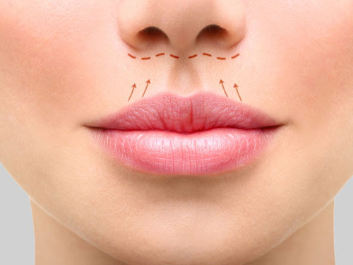 hirursko uvecanje usana