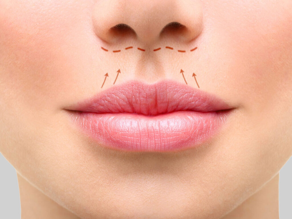 hirursko uvecanje usana