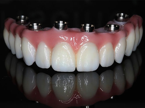 Proteze na implantima