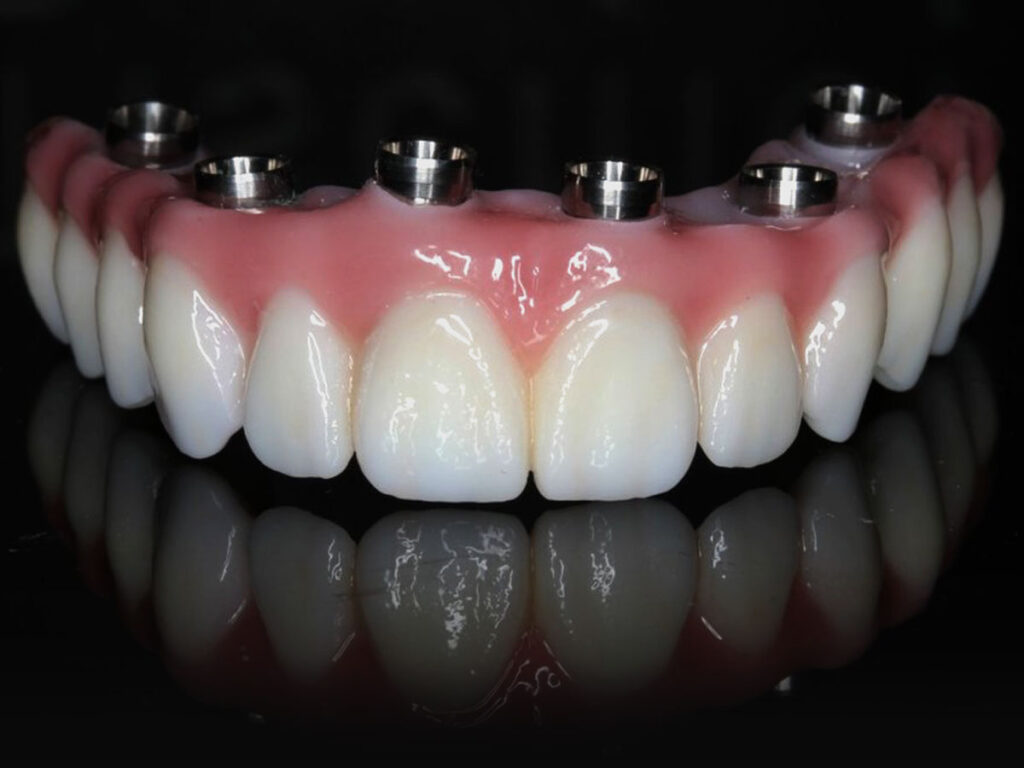 Proteze na implantima